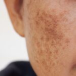 Qual Principia é bom para Melasma: Confira os 8 melhores